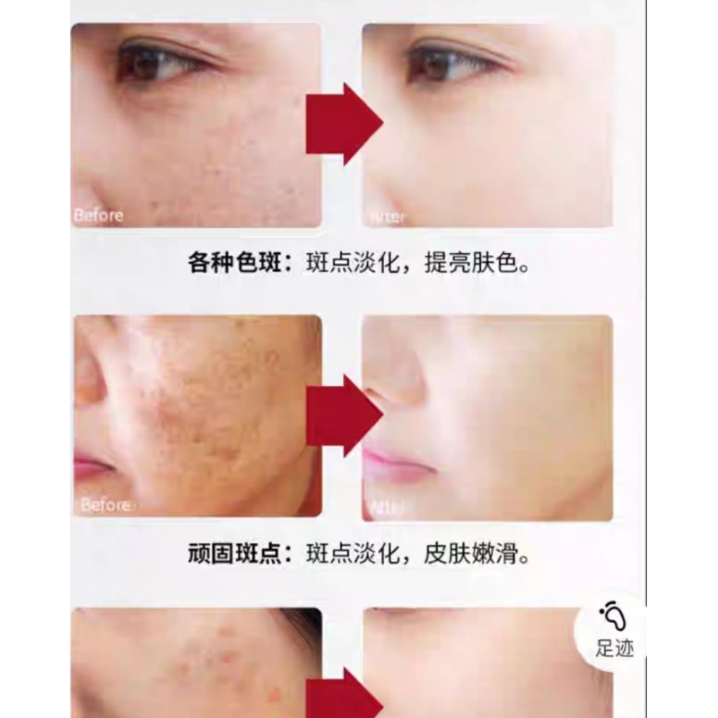 Viên Bôi Tinh Chất LANSIYI Mờ Nám Tàn Nhang, Thâm Mụn, Trẻ Hóa Trắng Da (Hộp 30 Viên x0,5ml)