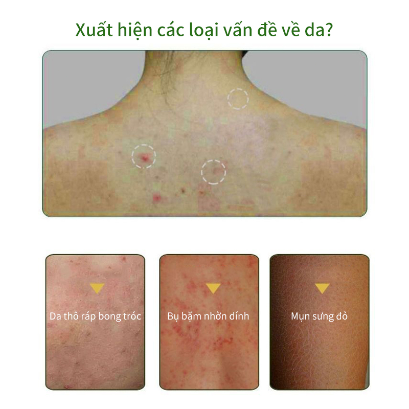 Sữa tắm mụn lưng Sữa tắm lưu huỳnh sữa tắm trắng 500ml Loại bỏ mụn trứng cá và ve ngứa Làm mới kiểm soát dầu