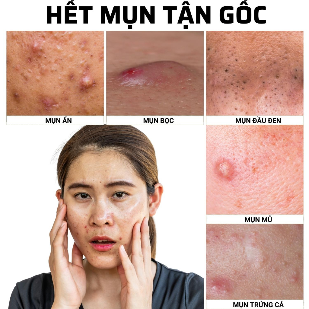 Serum Giảm Mụn Doctor Care Serum Mụn Đầu Đen Cho Da Dầu 20 ml