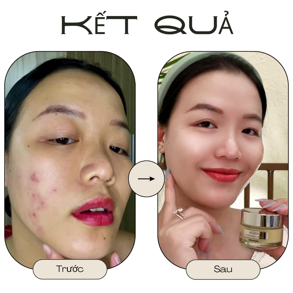 Kem Giảm Mụn Ẩn ,Mụn Đầu Đen ,Mụn Thâm Doctor Care Acnes Elimination cream Cho Da Dầu 30g