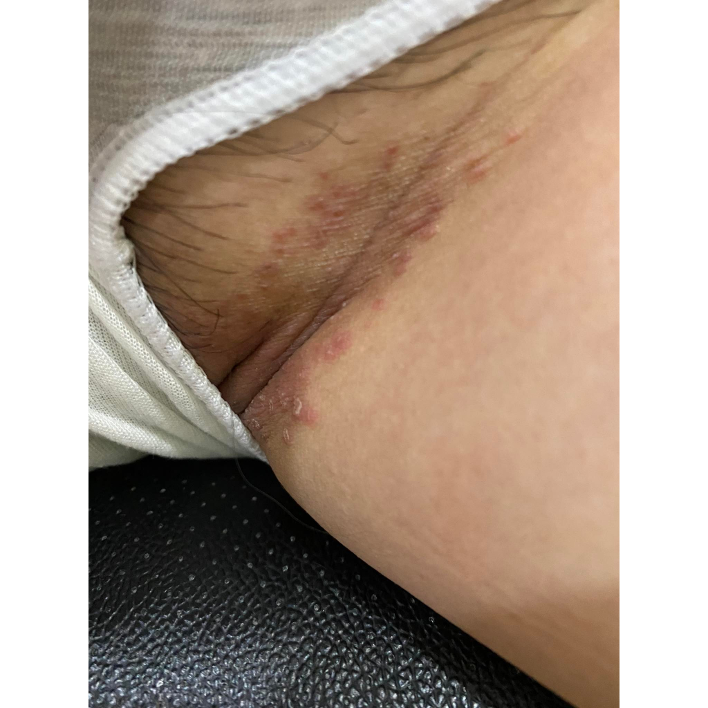 Thảo dược đánh bay Viêm Da, Hăm, Xoét, Mọc Mụn, Ngứa Ngáy, //H.á.n.g//B.ẹ.n//, Mu, Kẽ Khe Mông _Đông Y