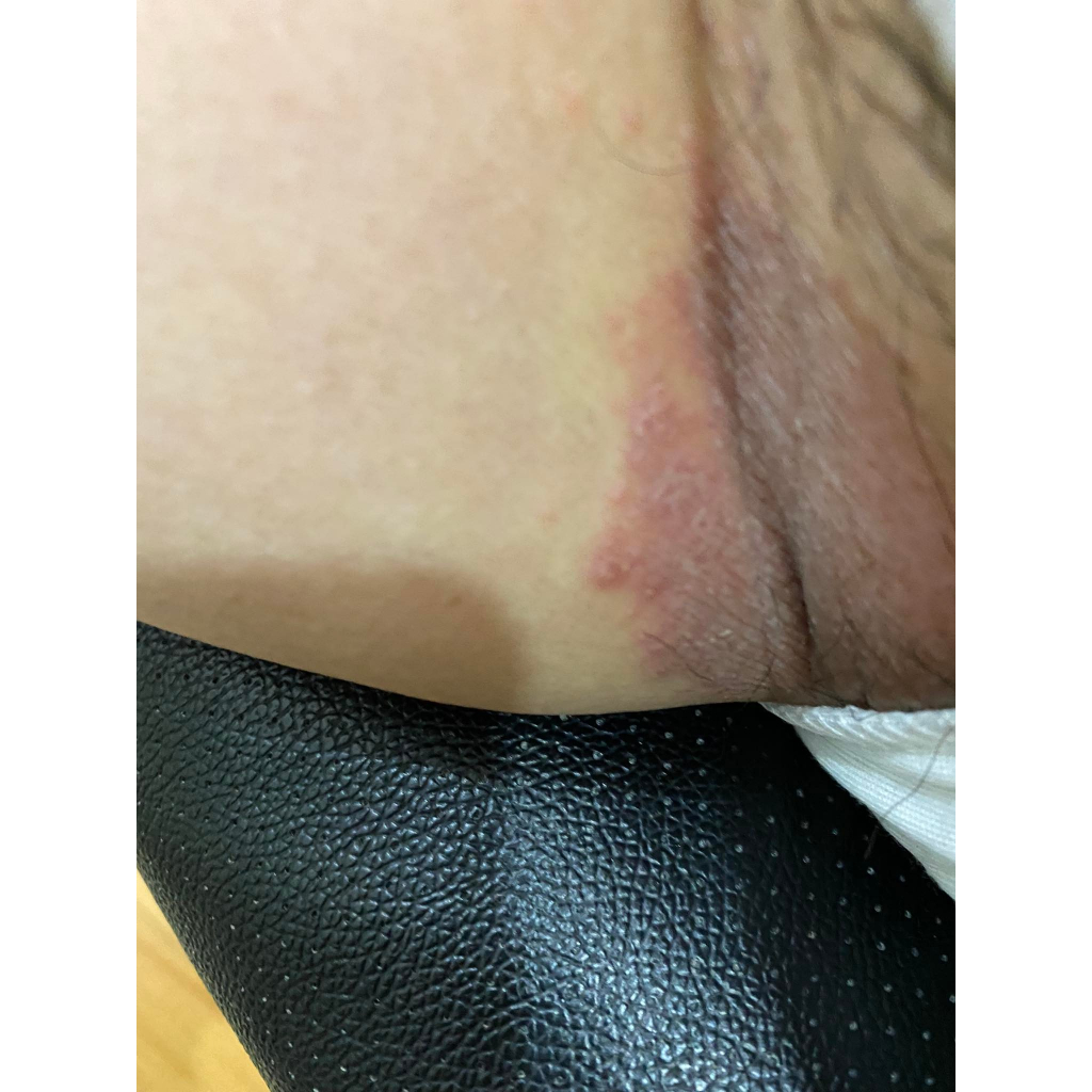 Thảo dược đánh bay Viêm Da, Hăm, Xoét, Mọc Mụn, Ngứa Ngáy, //H.á.n.g//B.ẹ.n//, Mu, Kẽ Khe Mông _Đông Y