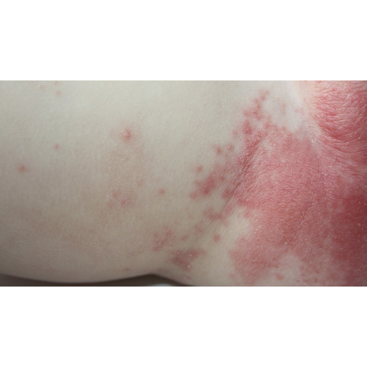 Thảo dược đánh bay Viêm Da, Hăm, Xoét, Mọc Mụn, Ngứa Ngáy, //H.á.n.g//B.ẹ.n//, Mu, Kẽ Khe Mông _Đông Y