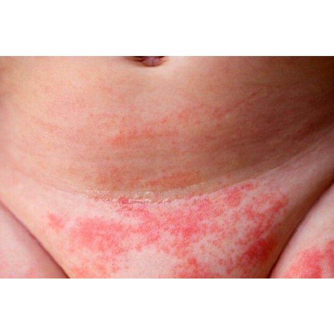 Thảo dược đánh bay Viêm Da, Hăm, Xoét, Mọc Mụn, Ngứa Ngáy, //H.á.n.g//B.ẹ.n//, Mu, Kẽ Khe Mông _Đông Y