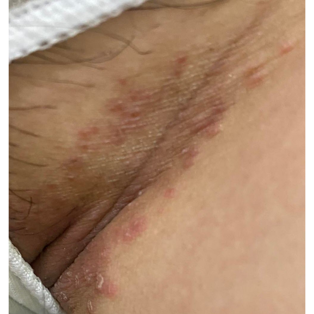 Thảo dược đánh bay Hăm, Xoét, Mọc Mụn, Viêm Da, Ngứa Ngáy, //H.á.n.g//B.ẹ.n//, Mu, Kẽ Khe Mông _Đông Y