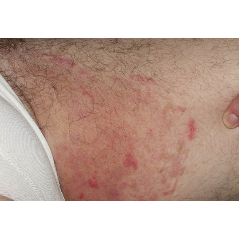 Thảo dược đánh bay Hăm, Xoét, Mọc Mụn, Viêm Da, Ngứa Ngáy, //H.á.n.g//B.ẹ.n//, Mu, Kẽ Khe Mông _Đông Y