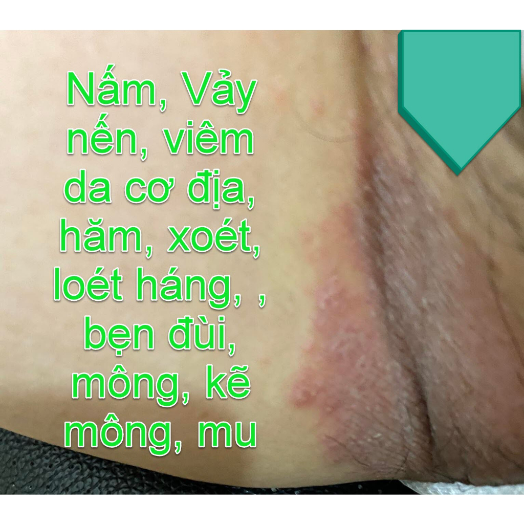 Thảo dược đánh bay Hăm, Xoét, Mọc Mụn, Viêm Da, Ngứa Ngáy, //H.á.n.g//B.ẹ.n//, Mu, Kẽ Khe Mông _Đông Y