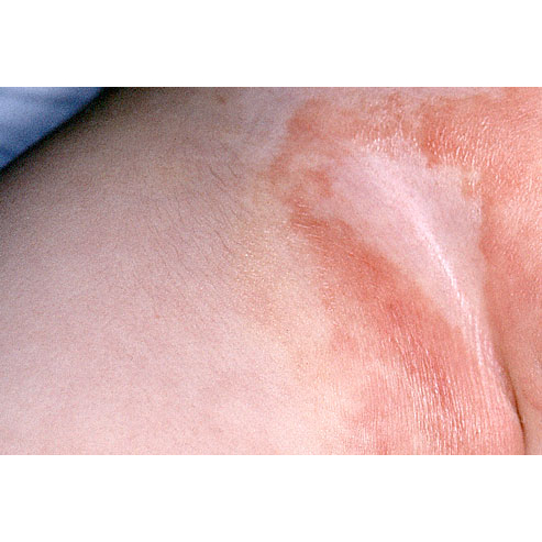 Thảo dược đánh bay Hăm, Xoét, Mọc Mụn, Viêm Da, Ngứa Ngáy, //H.á.n.g//B.ẹ.n//, Mu, Kẽ Khe Mông _Đông Y