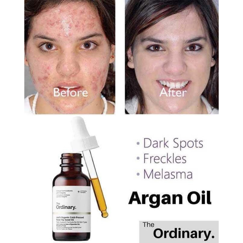 Tinh dầu dưỡng da cấp ẩm, dưỡng sáng da Rose Hip Seed Oil 30ml