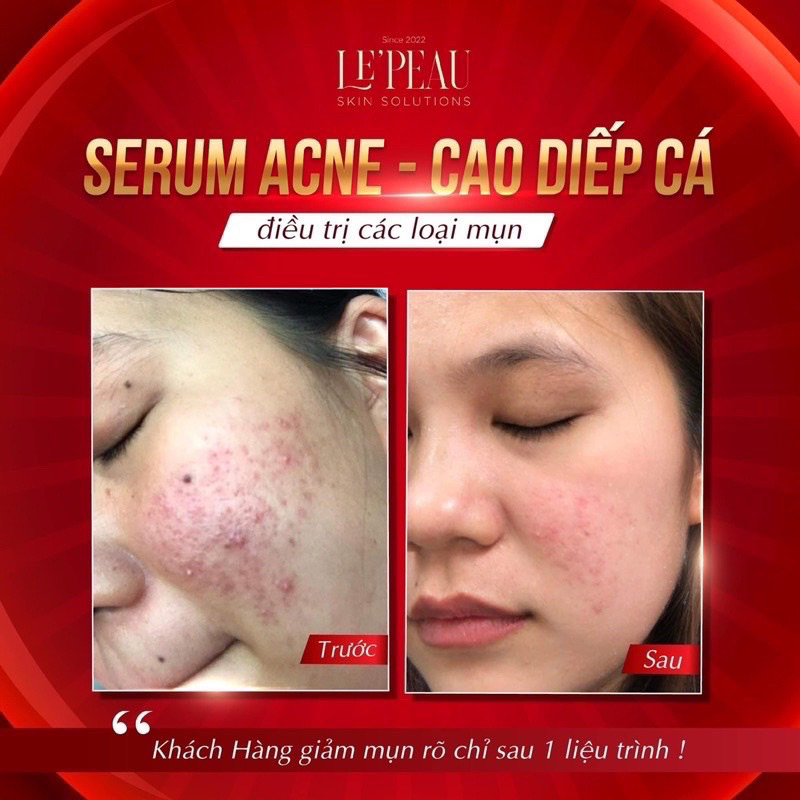 Le'peau Giảm Mụn Thâm Rỗ Lepeau Acne Serum . Le peau Bôi Mụn Trắng Sáng Khô Còi Mụn, Thâm Sâu Mụn Lọ 5ml