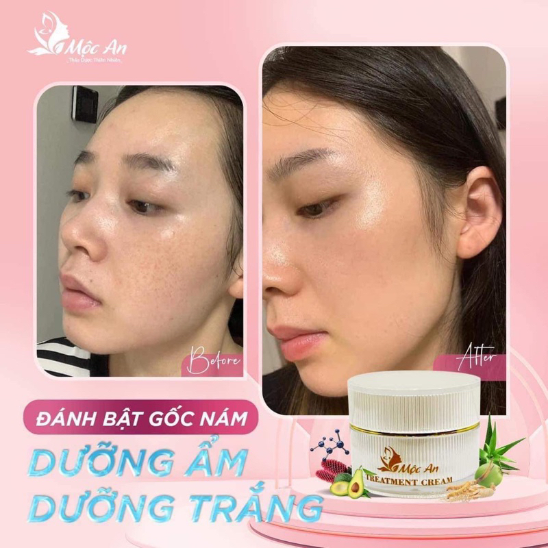 Combo cao nám Mộc An ngày và đêm hết nám trắng da