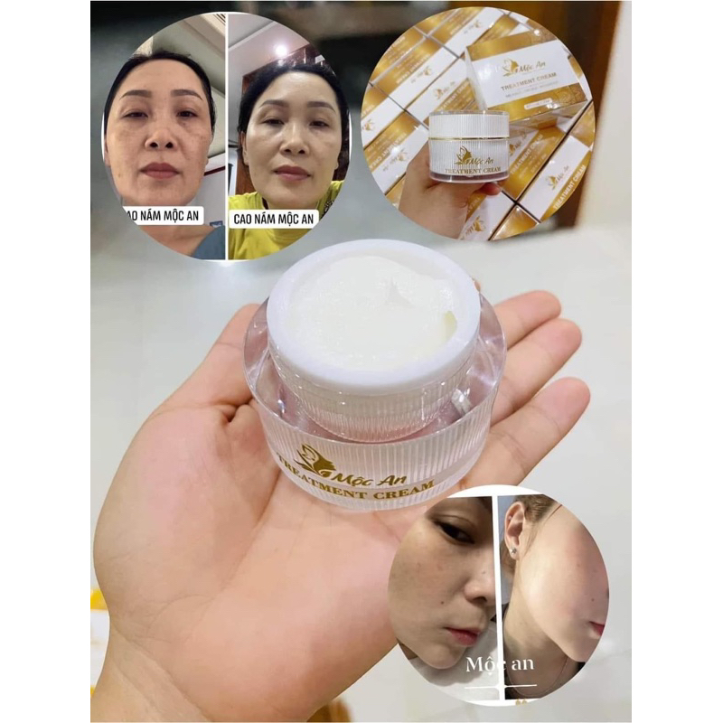 Combo cao nám Mộc An ngày và đêm hết nám trắng da