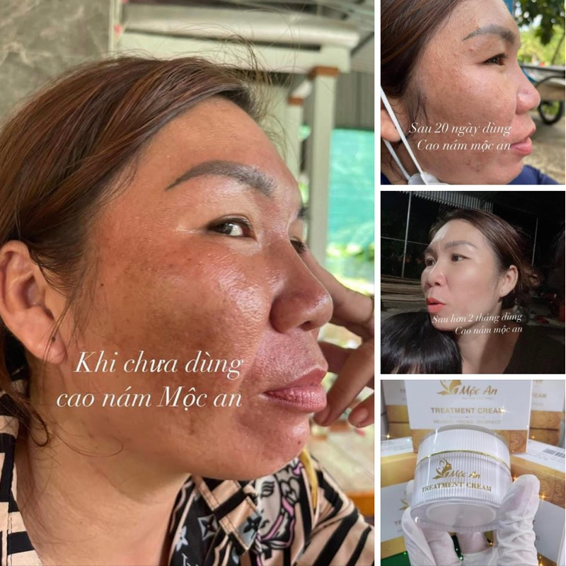 Combo cao nám Mộc An ngày và đêm hết nám trắng da
