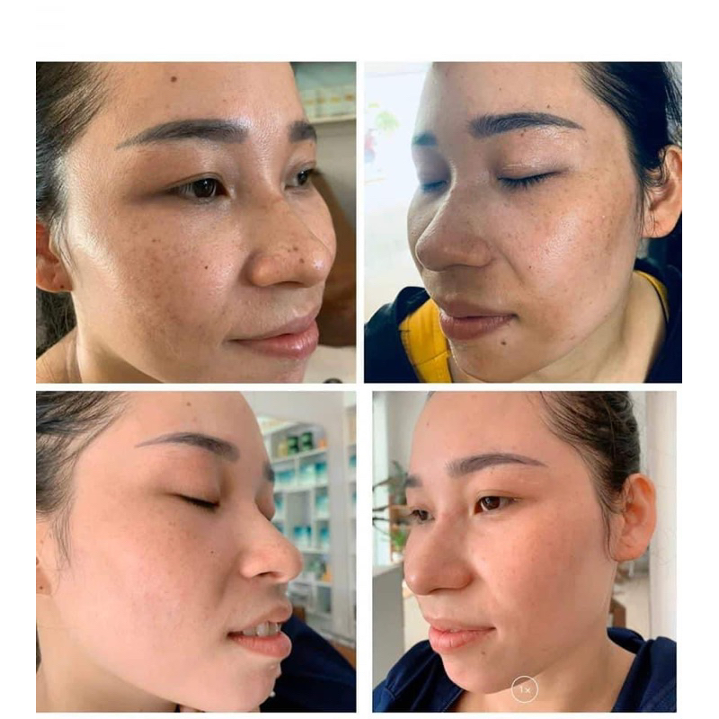 Combo cao nám Mộc An ngày và đêm hết nám trắng da