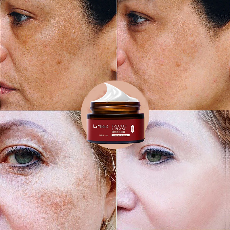 Kem xóa tàn nhang kem xóa nám làm trắng da tinh chất chất làm trắng da mặt và loại bỏ nám làm sáng da chăm sóc 30g