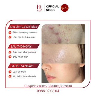 SERUM MỤN HAKI (New) • GINGEM ACNE ✔️