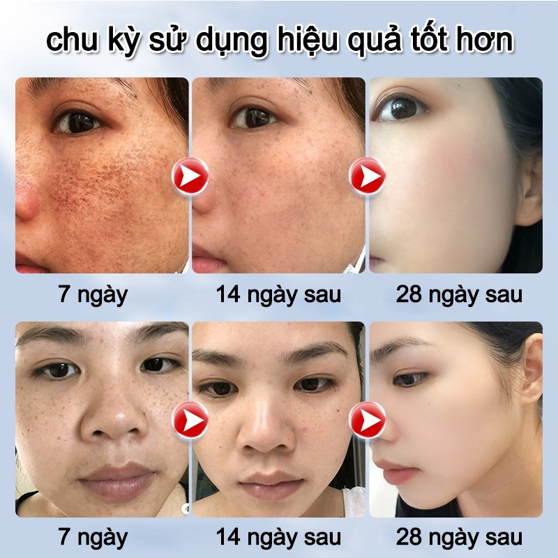 Tinh chất làm trắng sạch tàn nhang Kem trắng da và xóa tàn nhang Hiệu quả làm mờ thâm nám tàn nhan chống nám Làm trắng