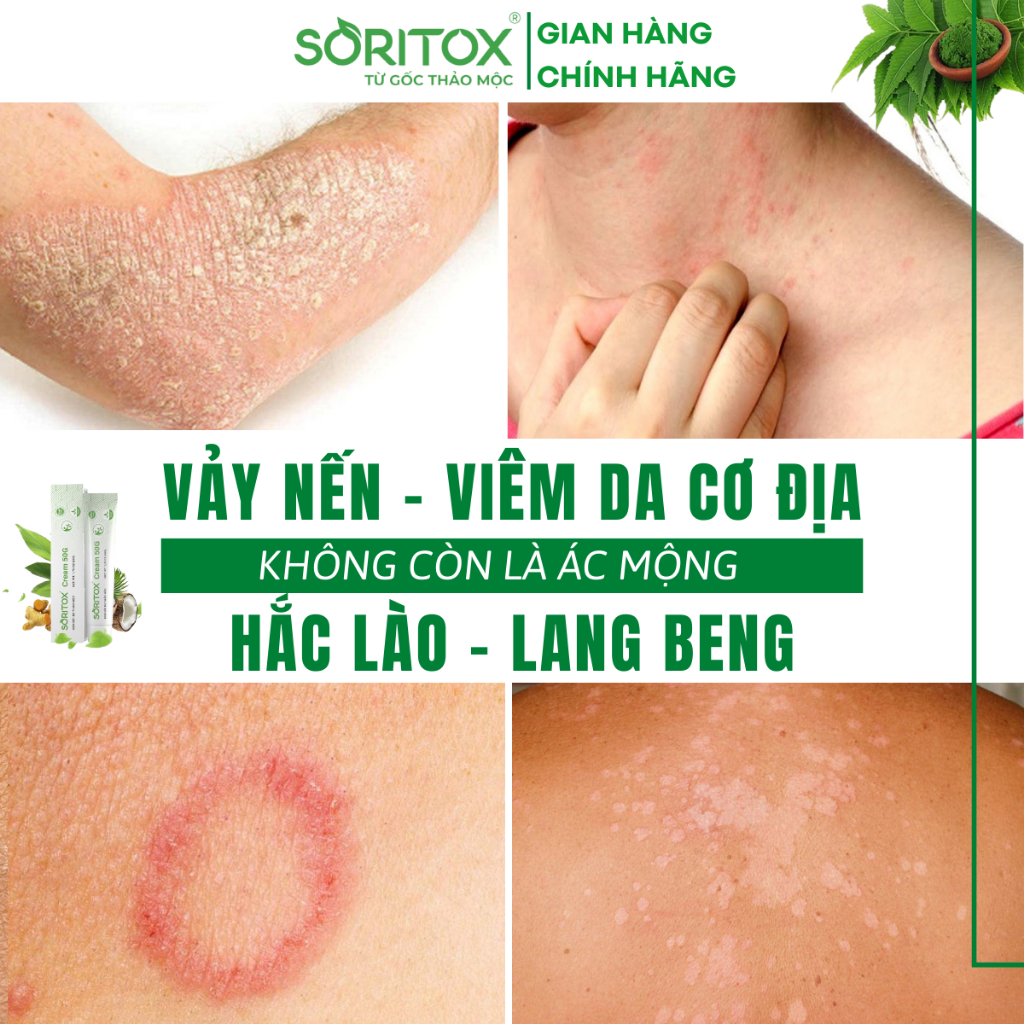 Kem Soritox 50GR - Xử Lý Vảy nến, Viêm da cơ địa, Mẩn ngứa, Bong tróc, Hắc lào