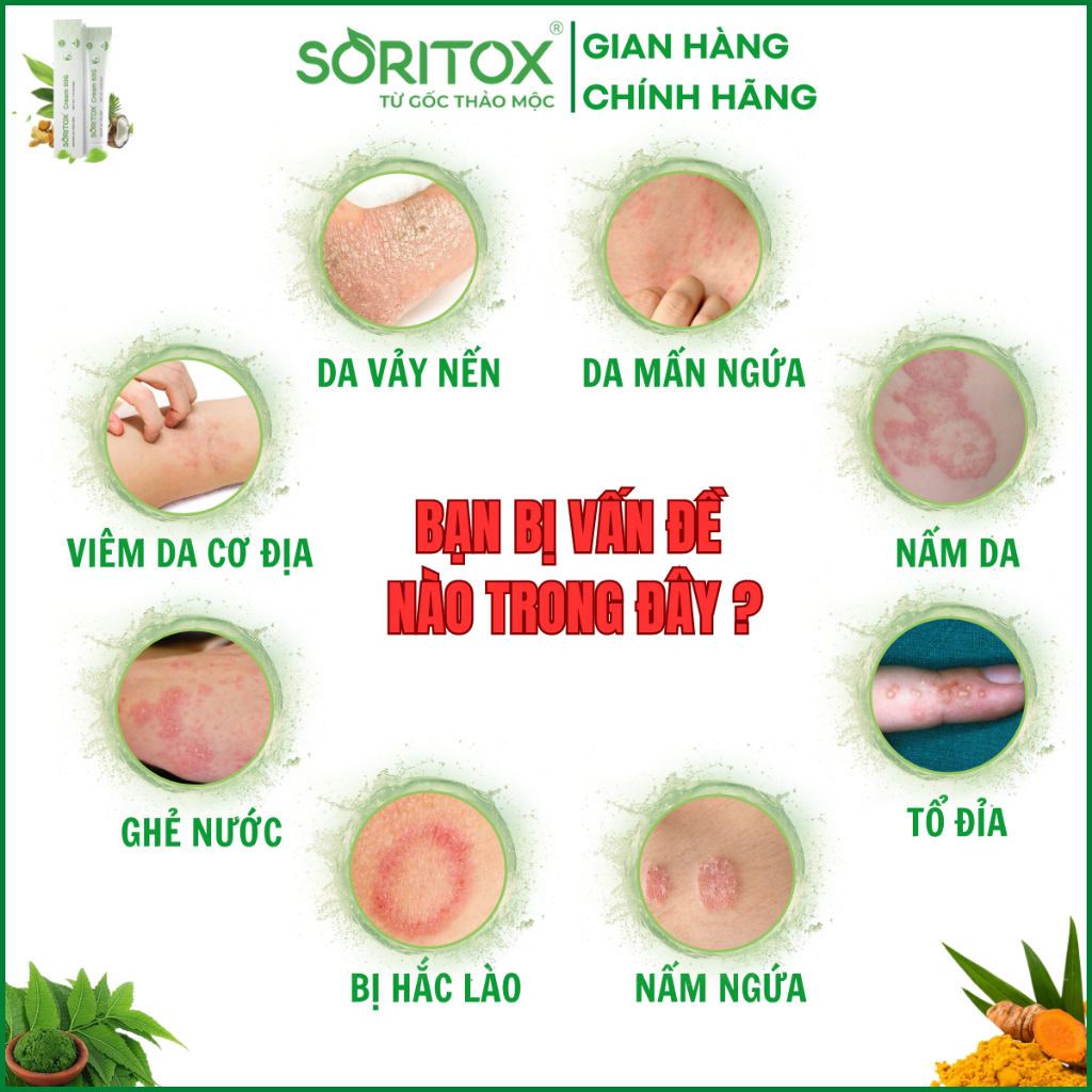 Kem Soritox 50GR - Xử Lý Vảy nến, Viêm da cơ địa, Mẩn ngứa, Bong tróc, Hắc lào