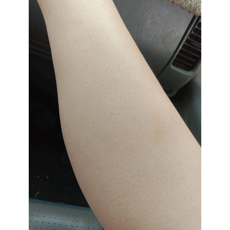 Kem Viêm nang Lông