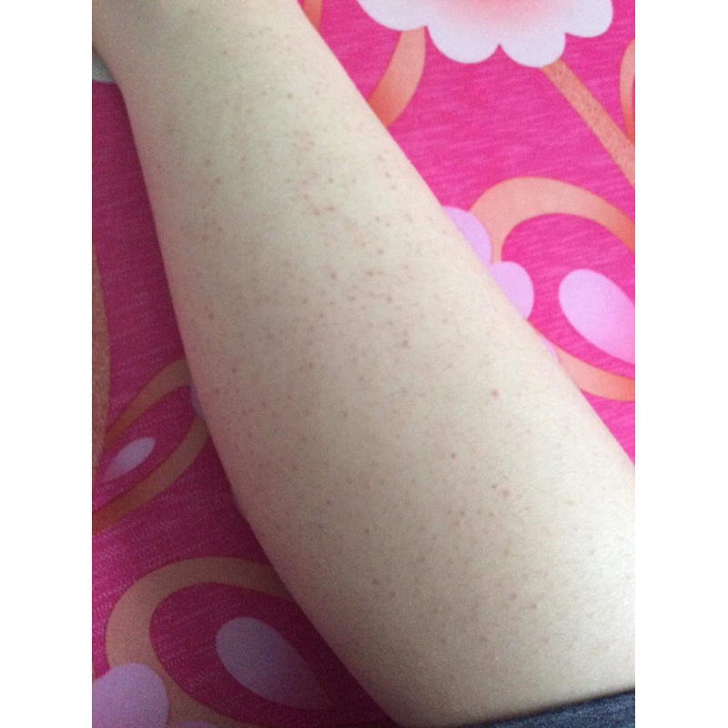 Kem Viêm nang Lông