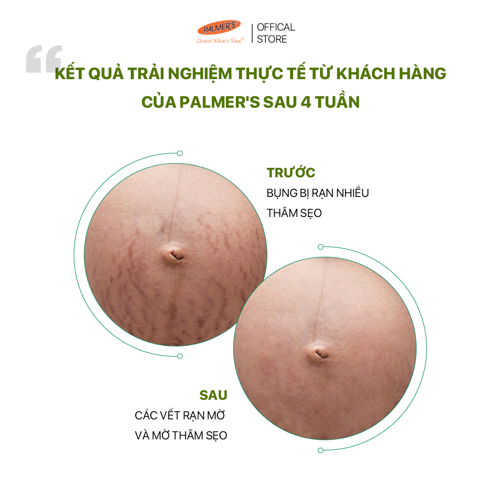 Lotion ngăn ngừa và giảm rạn da khi mang thai hoặc tăng cân Palmer's 50ml