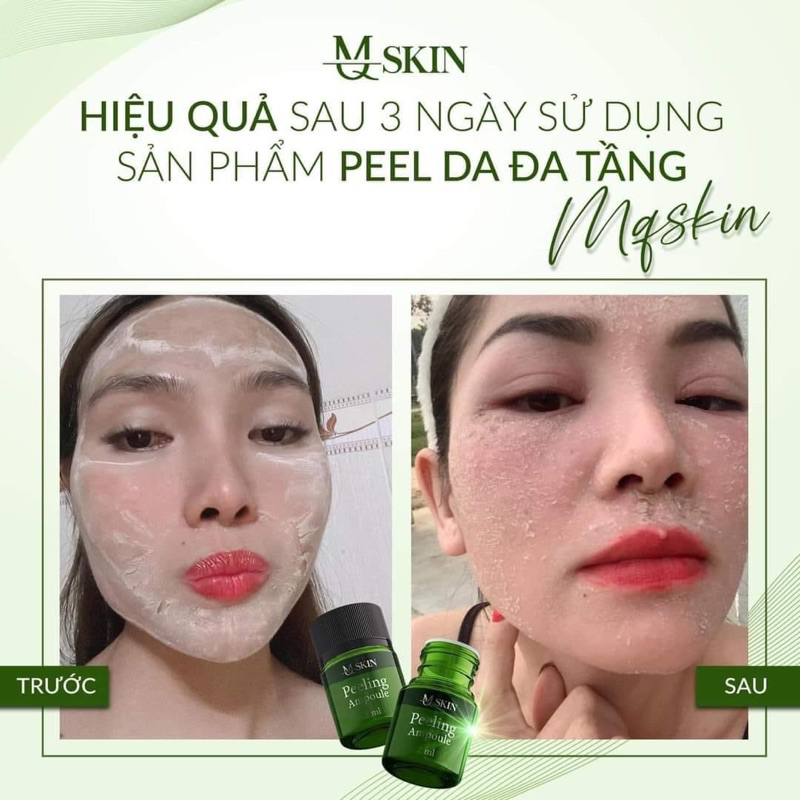 Peel Da Sinh Học Đa Tầng MQ Skin Chính Hãng Tái Tạo Da MQSKin