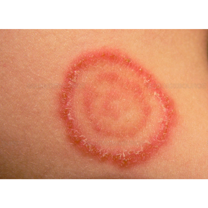 Thảo dược Hết Hẳn Nấm ngứa, Nấm hình tròn, Nấm đồng xu, Háng, Bụng, Đùi, Mông _Luôn Sẵn có