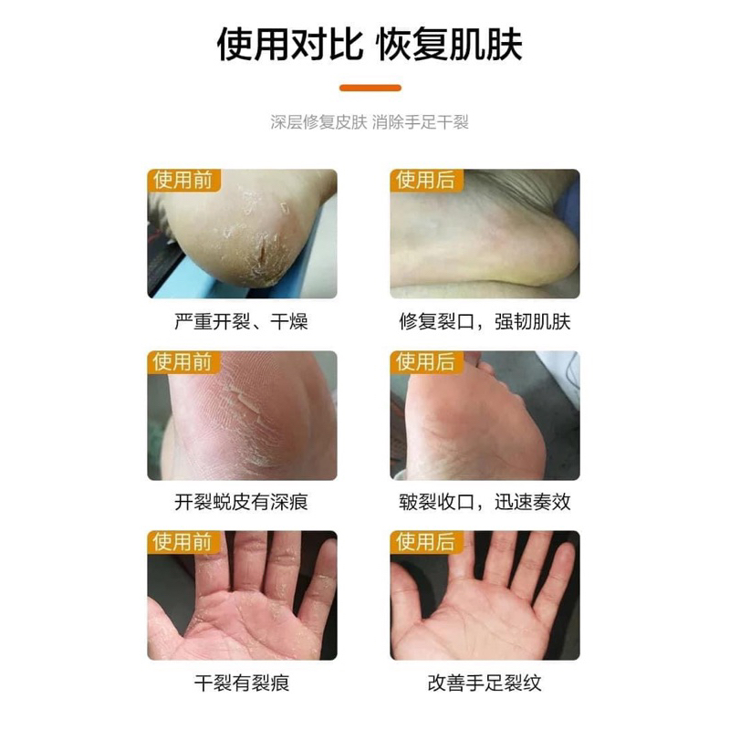 Kem dưỡng dành cho gót chân khô nẻ