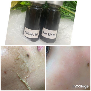 10ml Hút Sắc Tố nám lâu năm, nám mảng, nám chân sâu, tàn nhang- Spa chuyên dùng