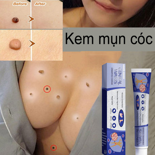 Kem tẩy nốt ruồi Loại bỏ mụn cóc serum tẩy nốt ruồi xóa mụn ruồi trên mặt, tàn nhang, mụn cóc,mụn thịt 20g