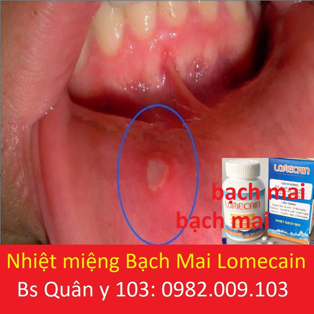 Lọ 500 viên Lomecain nhiệt miệng bạch mai