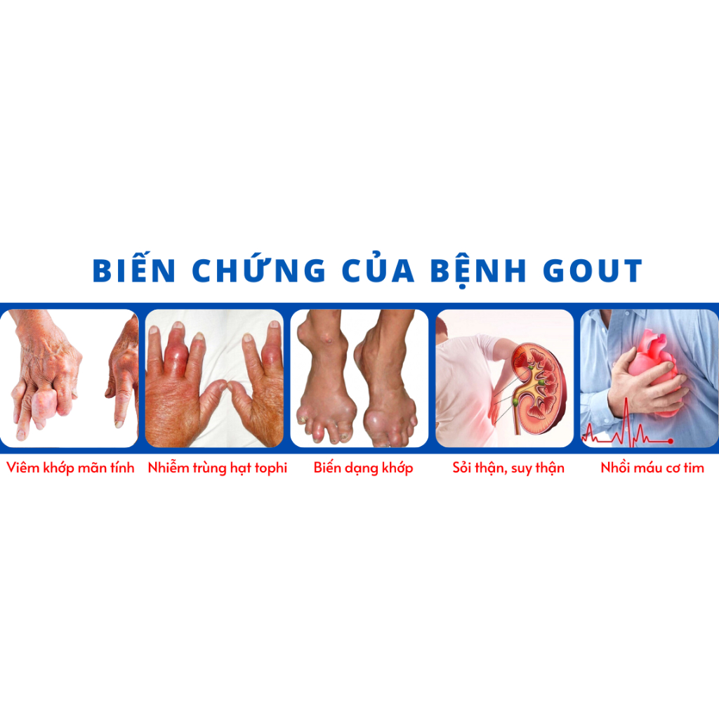 HÀ THỐNG PHONG - XUA TAN NỖI LO VỀ GÚT  -  GÚT CẤP, GÚT MẠN TÍNH, GIẢM AXIT URIC