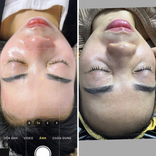 sheelab - Melasma 2 (Ức chế nám không bong), Clab (bước 2)
