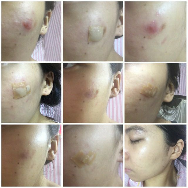 Miếng dán mụn viê.m, hút nhân mụn, vết thương hở, bỏng bô... Duoderm Extra Thin