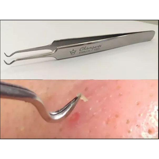 Măng tây baby - Que/Nhíp Gắp Mụn Đầu Đen, Mụn Dưới Da Thông Minh Thép Không Gỉ