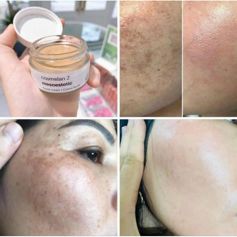 Kem giảm nám Mesoestic Cosmelan 2