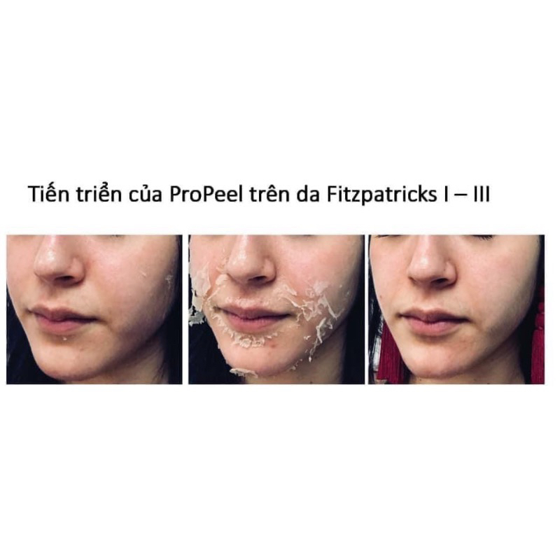 Vivant pro peel