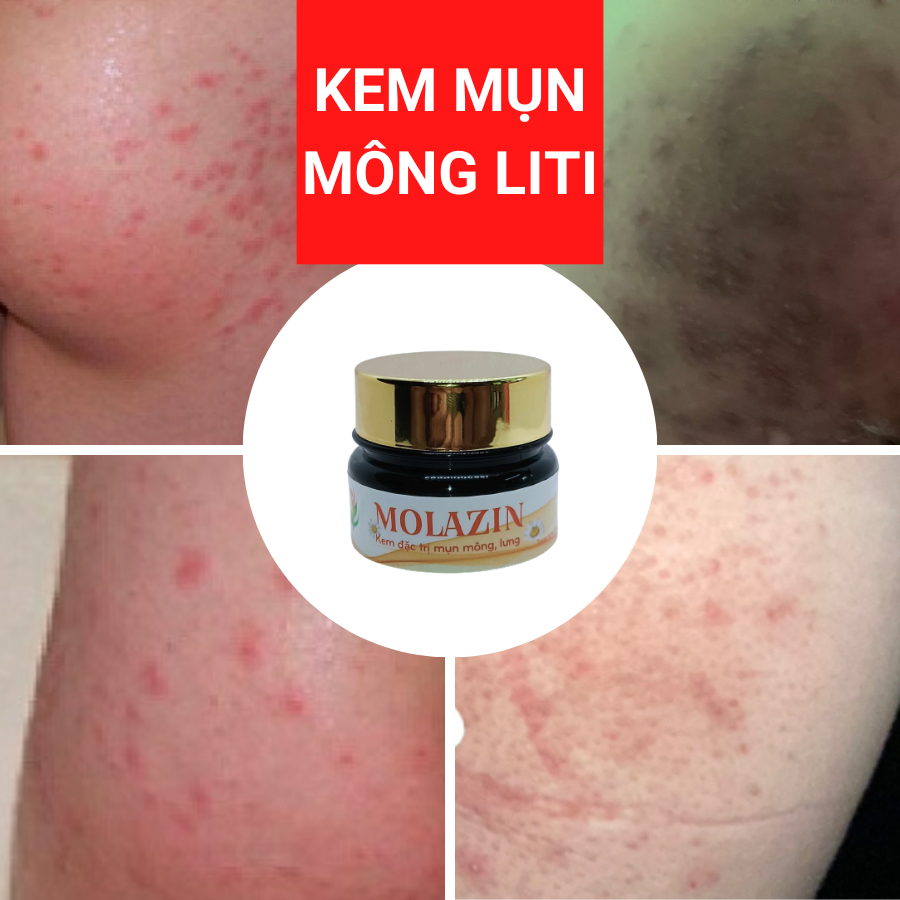 Kem mụn Mông Mụn Lưng Molazin cải thiện rõ an toàn mụn li ti, mụn nhọt, viêm nang lông