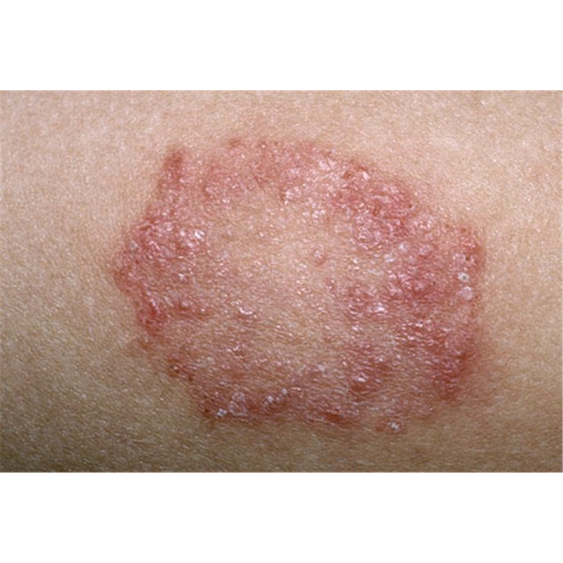 Thảo dược Hết Ngay Nấm ngứa, Nấm hình tròn, Nấm đồng xu, Hắc lào Háng, Bụng, Đùi, Mông