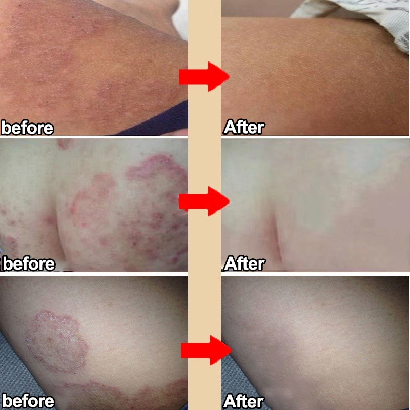 Chăm sóc vùng kín kem Kem giảm ngứa Dùng bên ngoài loại bỏ vùng kín Nấm Ngứa hôi hám kháng khuẩn Làm sạch sâu 30g