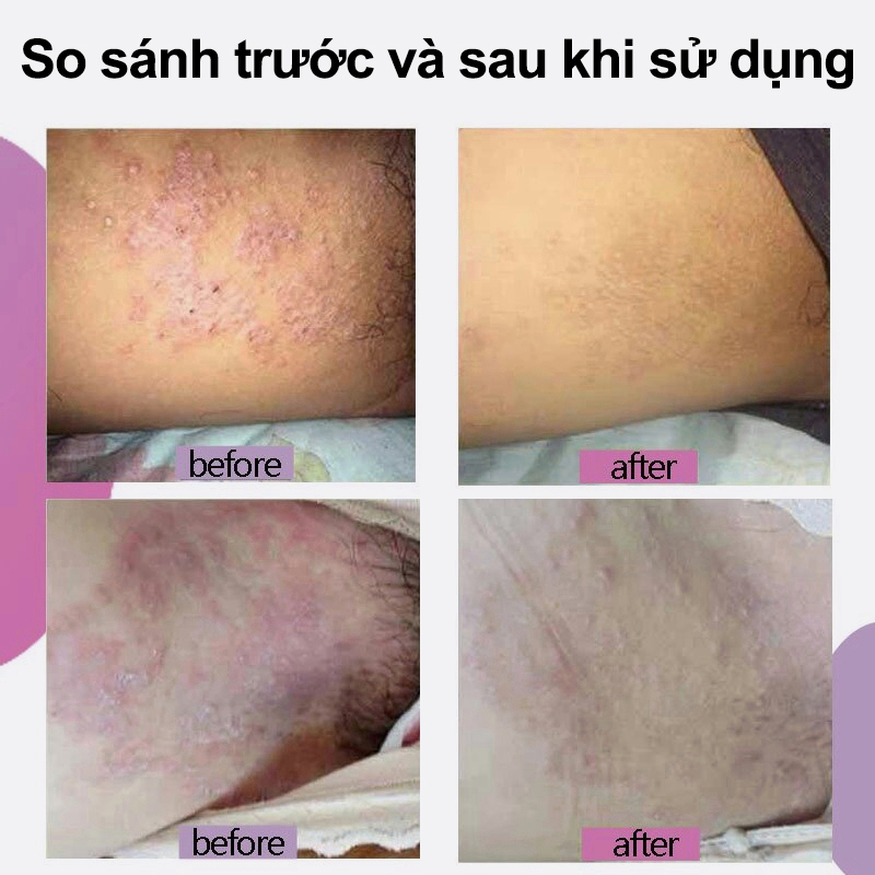 Chăm sóc vùng kín kem Kem giảm ngứa Dùng bên ngoài loại bỏ vùng kín Nấm Ngứa hôi hám kháng khuẩn Làm sạch sâu 30g