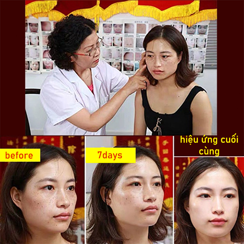 Tinh chất dưỡng serum trắng da tàn nhang kem nám tàn nhang 100ML giảm thâm se khít lỗ chân lông và trắng sáng da