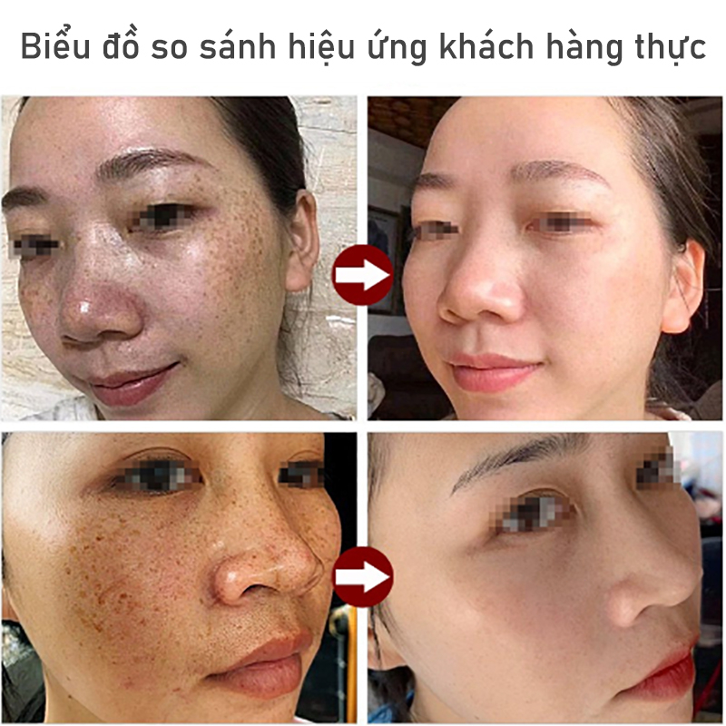 Tinh chất dưỡng serum trắng da tàn nhang kem nám tàn nhang 100ML giảm thâm se khít lỗ chân lông và trắng sáng da