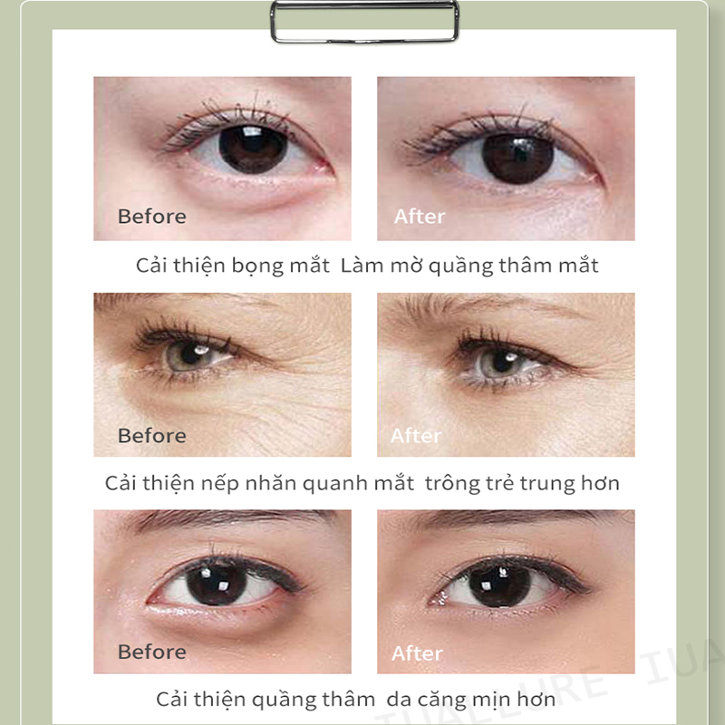 Kem nhăn mắt  kem xoá nhăn mắt  40g tinh chất chống lão loại bỏ các hạt mỡ loại bỏ quầng thâm