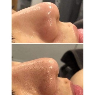 Ủ MỤN ĐẦU ĐEN REMOVE BLACKHEAD