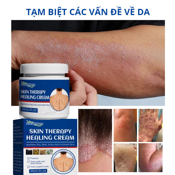 SKIN THERAPY HEALING CREAM - Kem bôi viêm da cơ địa nhập khẩu chính hãng 20g