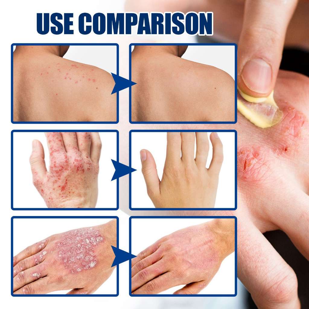 Kem Skin Therapy Healing bôi viêm da cơ địa, chống ngứa, chàm hộp 20g