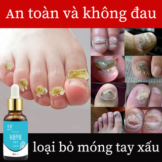 Kem trị nấm móng Serum đánh bay nấm móng dưỡng phục hồi móng loại bỏ nấm móng chân móng tay