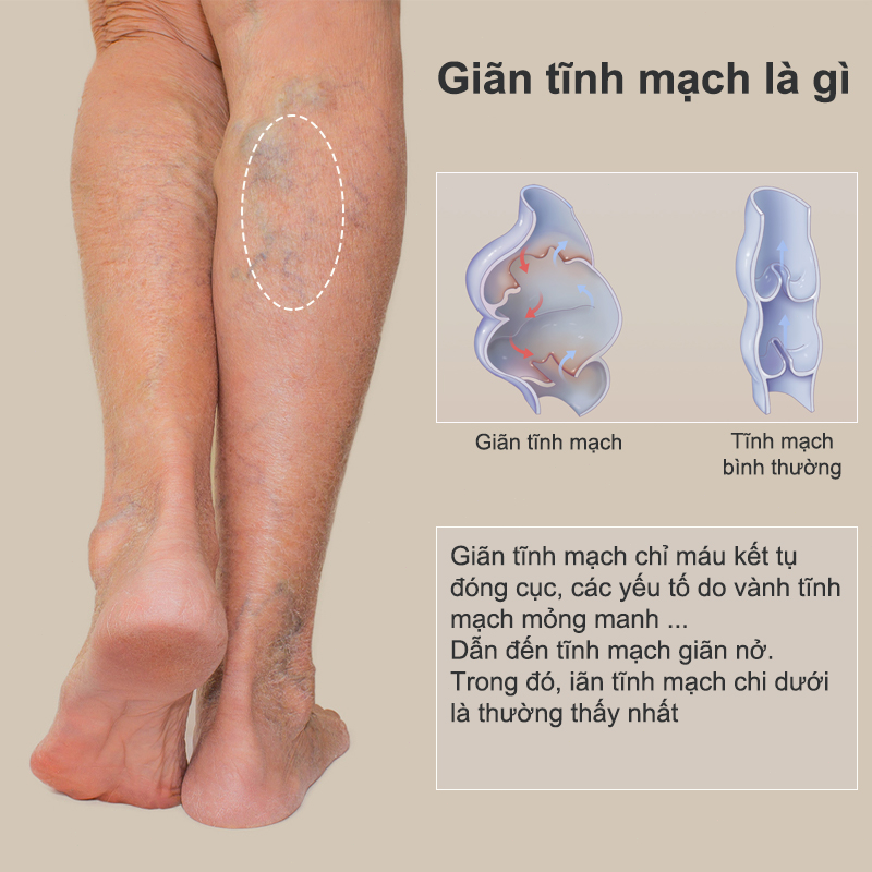 Kem suy giãn tĩnh mạch 20g giúp giảm đau mỏi tê phù chuột rút do suy giãn tĩnh mạch thúc đẩy tuần hoàn máu